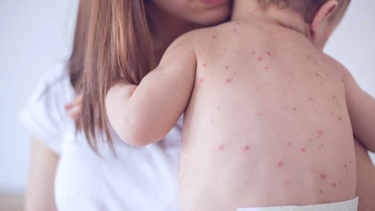 Child Death Toll Rises to 144 Amid Measles Symptoms Surge